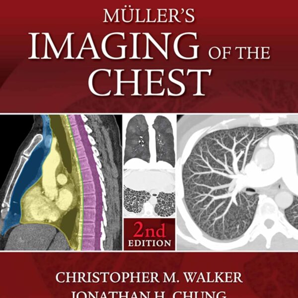 Muller's Imaging of the Chest: Expert Radiology Series